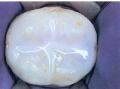 dental sealed tooth