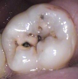 Cavity unsealed tooth